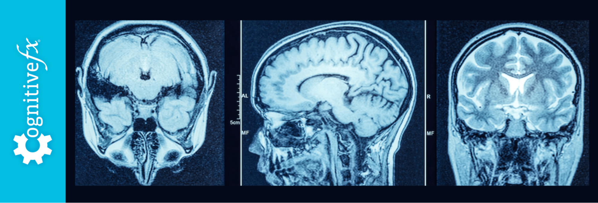 mild-covid-linked-to-brain-damage-what-that-means-for-you